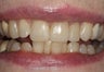 Restoration Following Dental Trauma
