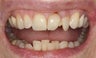 Restoration Following Dental Trauma