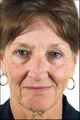 Rhinoplasty for a Mature Adult