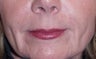 Soft Tissue Fillers Before & After Photos