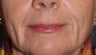 Soft Tissue Fillers Before & After Photos