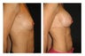 Breast Implants