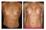 Breast Implants