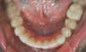 Correction of Blocked-Out Tooth and Deviated Midline with Invisalign