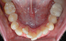 Correction of Blocked-Out Tooth and Deviated Midline with Invisalign