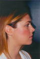 Facial Liposuction