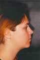 Facial Liposuction