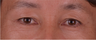 Endoscopic brow and forehead lift of 51-year-old man