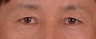 Endoscopic brow and forehead lift of 51-year-old man
