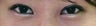 Bilateral Asian Eyelid Surgery