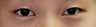 Bilateral Asian Eyelid Surgery