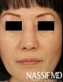 Asian Revision Rhinoplasty