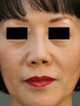 Asian Revision Rhinoplasty