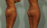 44 Year Old Female with Buttock Lift and Augmentation