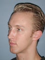 Chin Surgery on 28-year-old