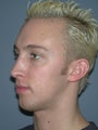 Chin Surgery on 28-year-old