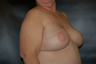 Breast Reconstruction