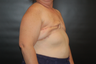 Breast Reconstruction