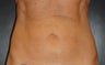 SmartLipo MPX