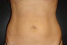 SmartLipo MPX