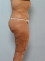 Body Lift