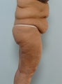 Body Lift