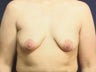 Breast Lift