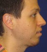 Chin Augmentation with Extended Anatomical Chin Implant