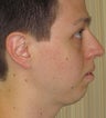 Chin Augmentation with Extended Anatomical Chin Implant