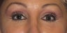 Lower Lid Blepharoplasty, with Fat Grafting up Upper and Lower Lids