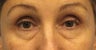 Lower Lid Blepharoplasty, with Fat Grafting up Upper and Lower Lids