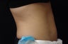 Coolsculpting Abdomen