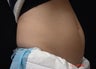 Coolsculpting Abdomen