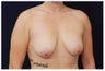 Breast Lift with Implants
