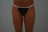 SmartLipo Inner and Outer Thighs