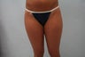 SmartLipo Inner and Outer Thighs
