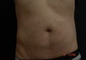 Coolsculpting Male Abdomen