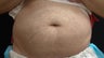 Coolsculpting Male Abdomen
