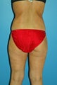 liposuction female patient
