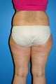liposuction female patient