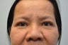 55 Year Old Female Treated for Droopy Eyelids