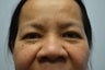 55 Year Old Female Treated for Droopy Eyelids