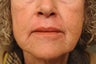 Perioral Dermabrasion