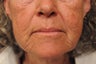 Perioral Dermabrasion
