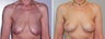 Breast Lift
