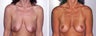 Breast Lift