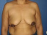 Breast Lift with Banelli