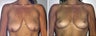 Breast Lift