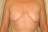 Full Mastopexy Augment to Correct Breast Asymmetry
