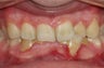 Invisalign